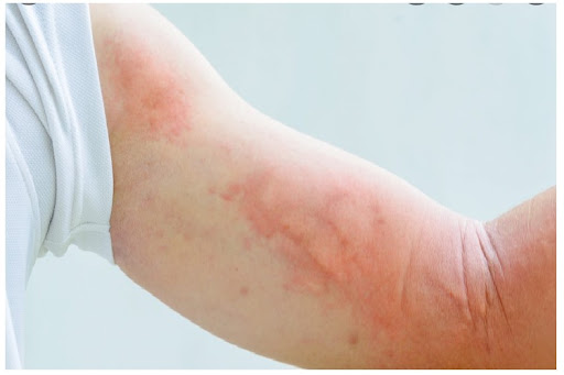 Mạt Bụi Trong Chăn Ga – Kẻ Thù Vô Hình Với Sức Khỏe Của Bé 15 Biểu hiện ở da và đường hô hấp của bé